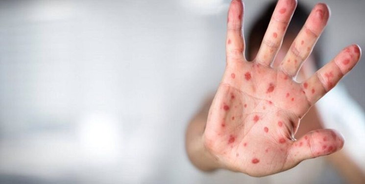 جزییات تازه از اولین مبتلا به آبله میمونی در اهواز